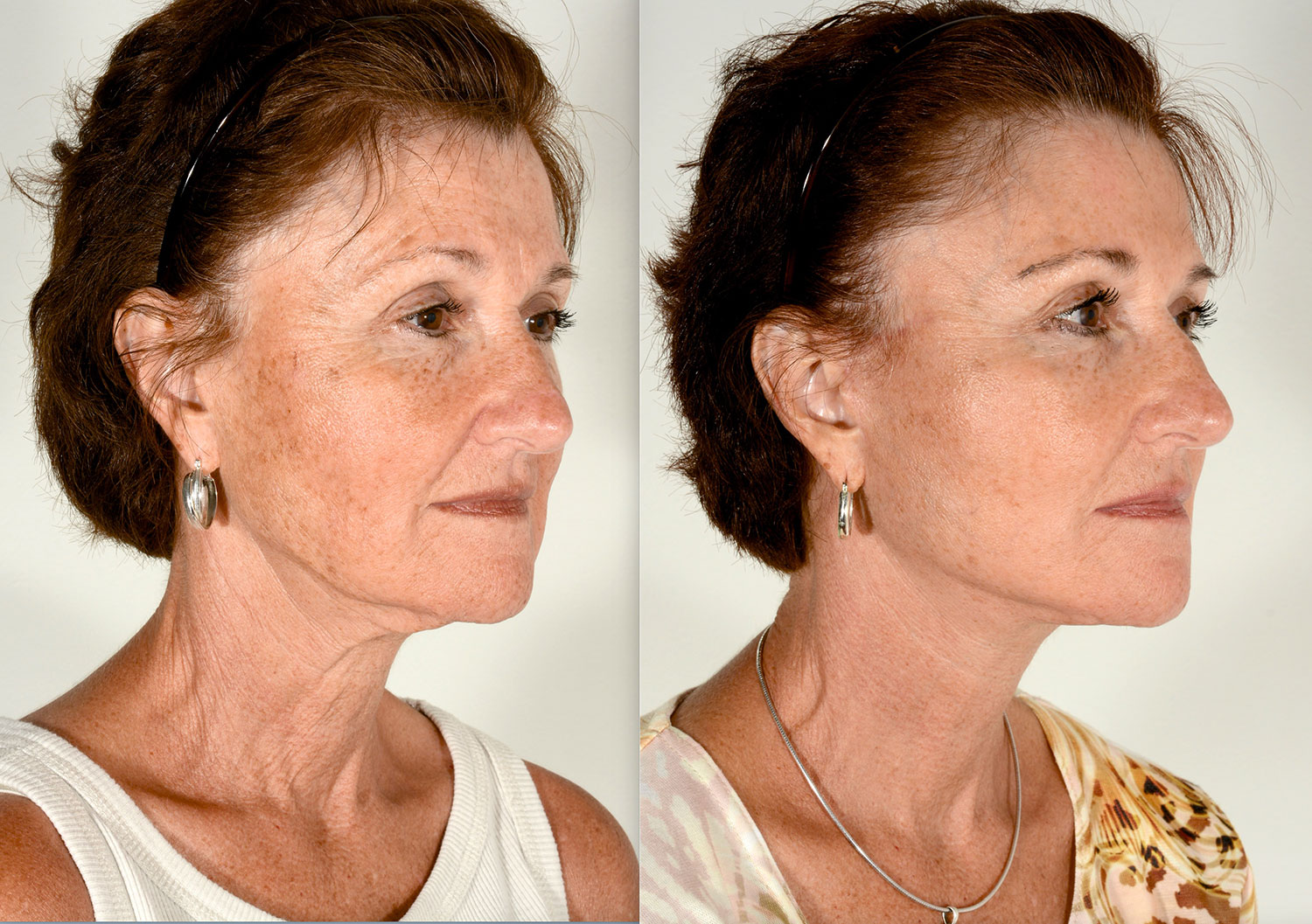 Facelift, Revision Facelift – Charleston Facial Plastic Surgery - SC