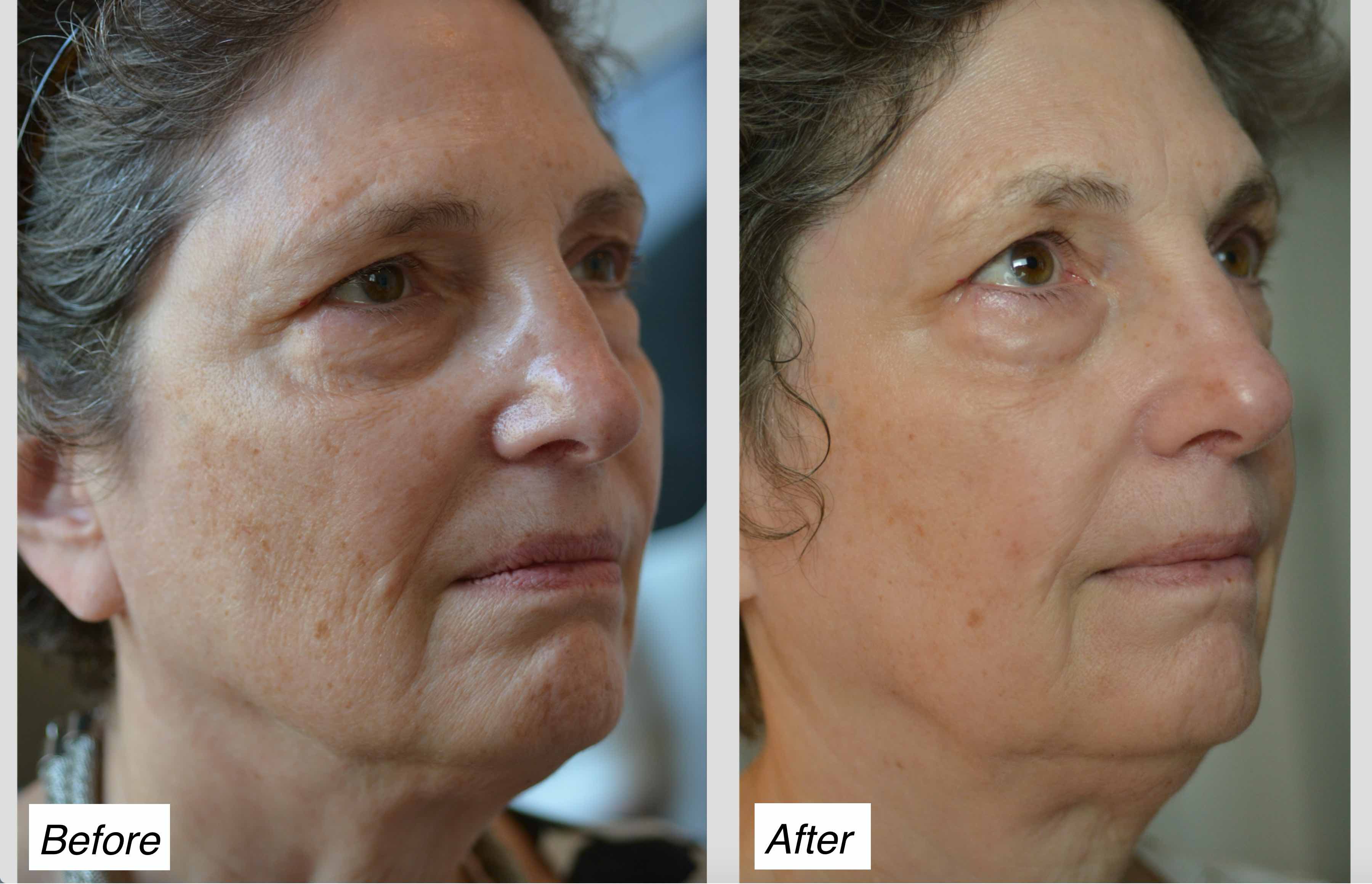 Laser Skin Resurfacing | Charleston | Charleston Facial 