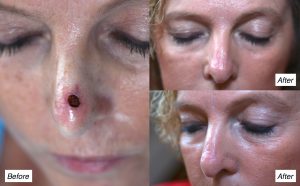 Mohs surgery charleston