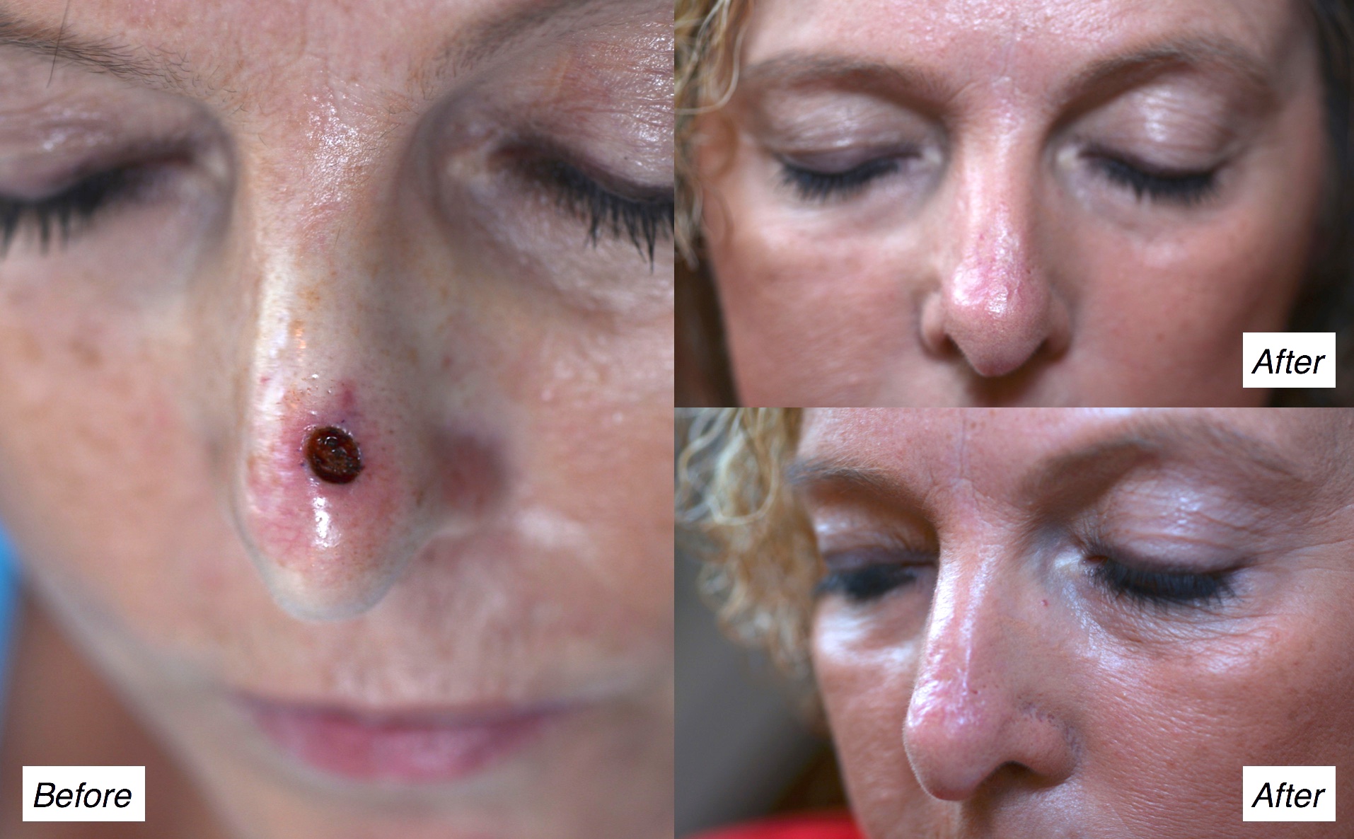 Mohs surgery charleston