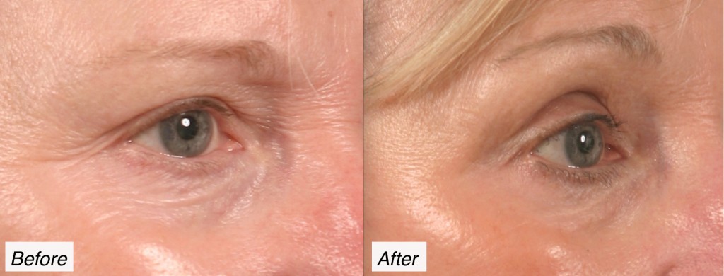 blepharoplasty and eyelid lift charleston, sc