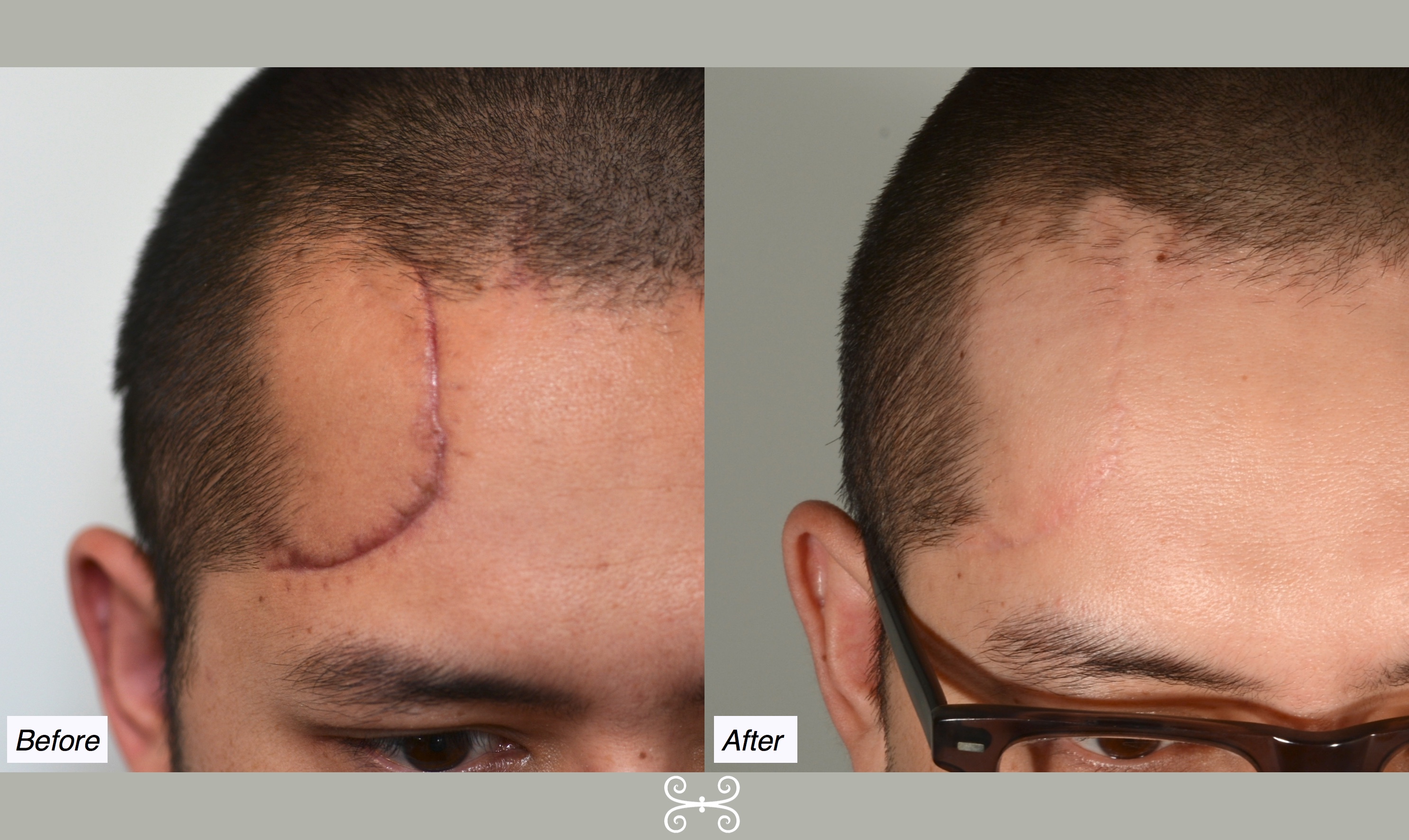 forehead scar 6months - Charleston Facial Plastic Surgery