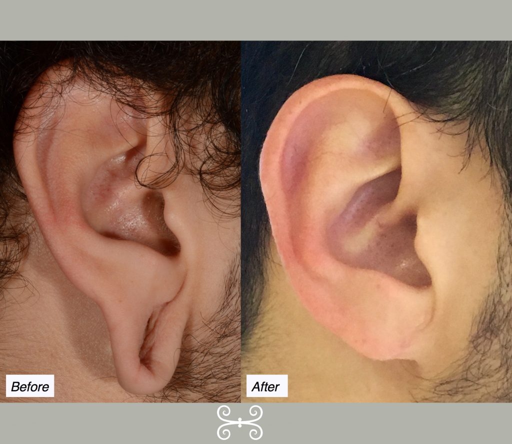 Repairing Gauge or Stretched Earlobes with Plastic Surgery