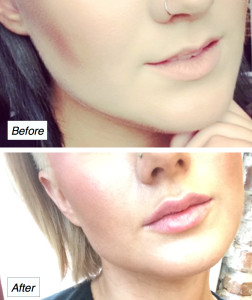 lip injections