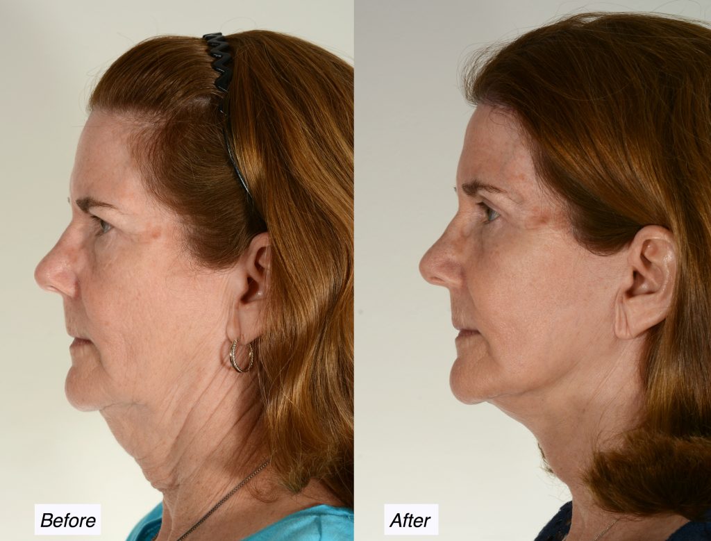 free neck plastic surgery