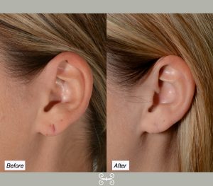 earlobe repair Charleston