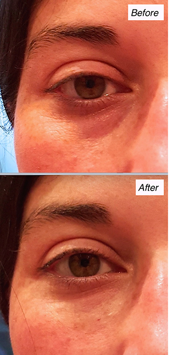 tear trough filler