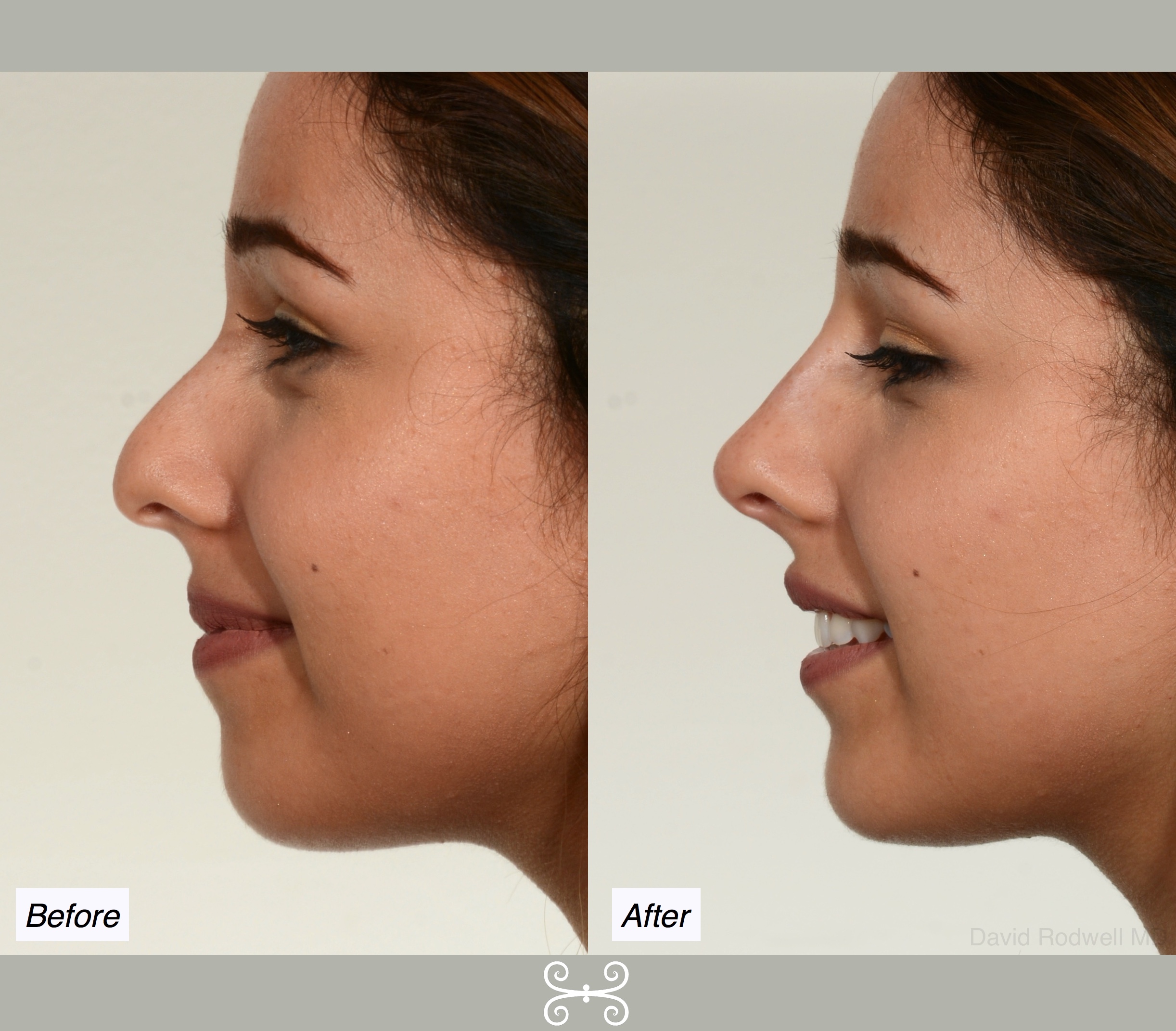 non surgical nose job.