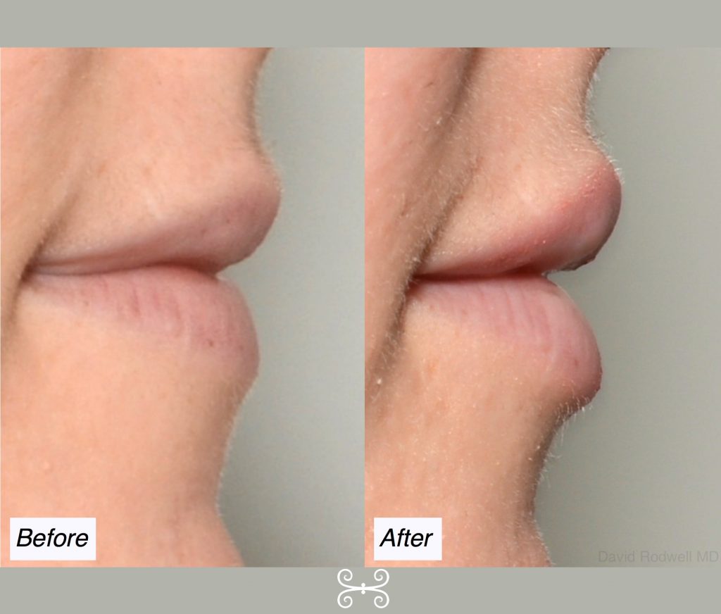 lip augmentation