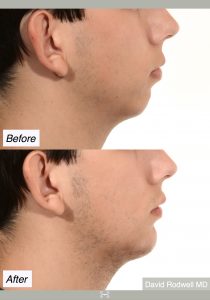 chin implant mt pleasant