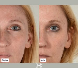 temple filler in charleston