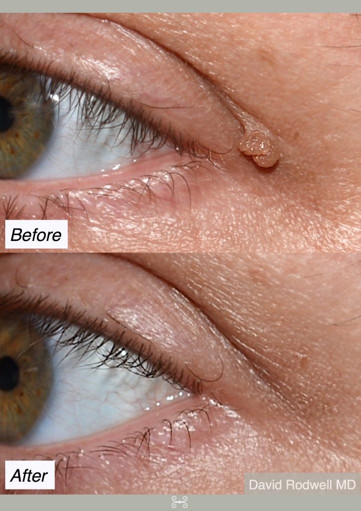 skin tag removal 