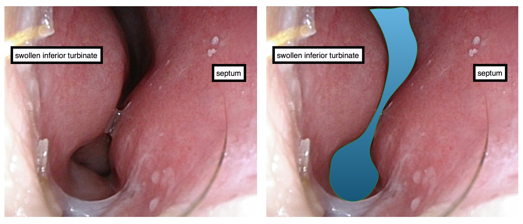 turbinate obstruction Charleston Facial Plastic Surgery