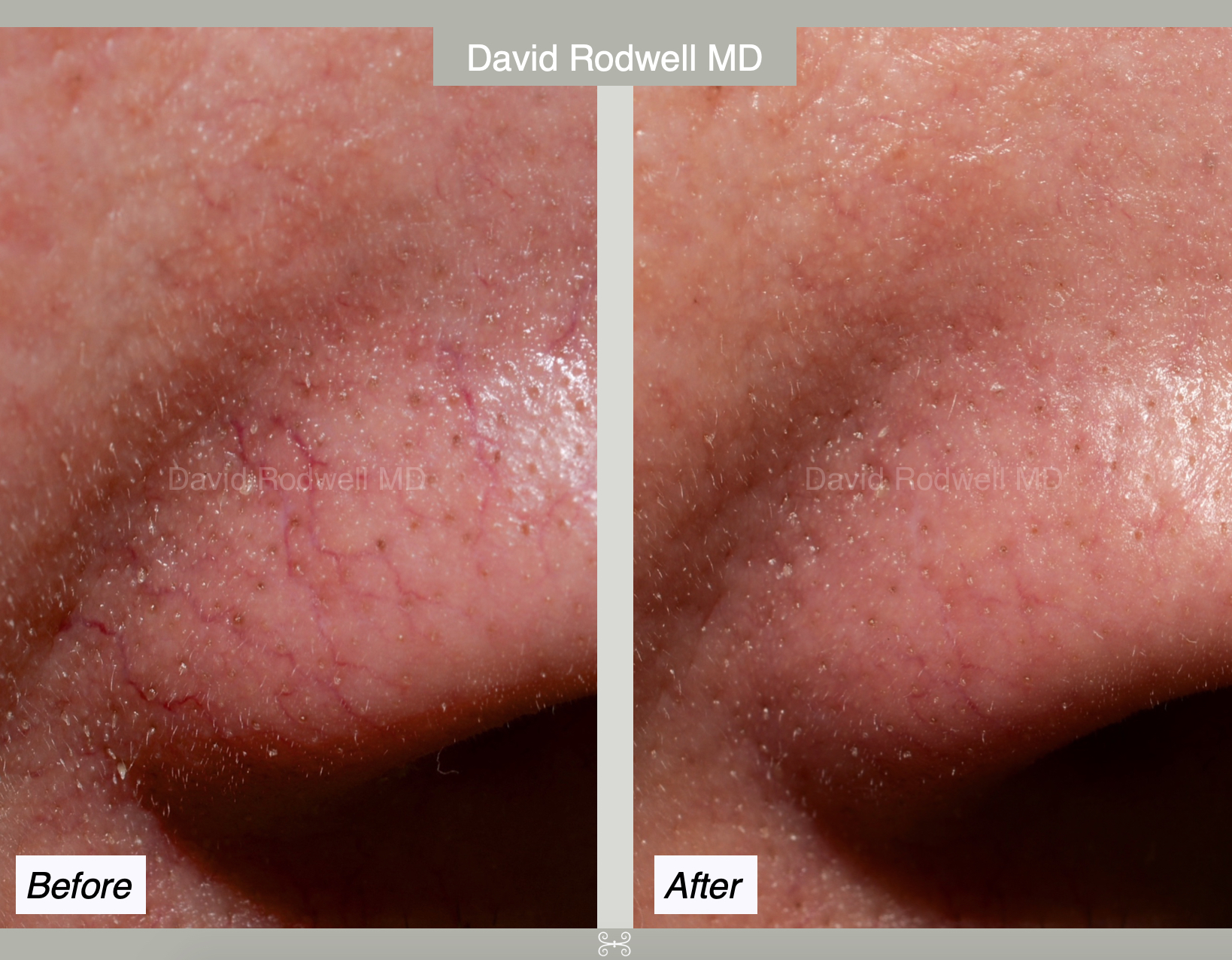 telangiectasia copy Charleston Facial Plastic Surgery